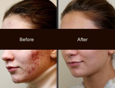 acne laser removal treatment skin scar scars cosmetic treatments cost rid pigmentation does solution scarring resurfx jaipur india severe lesions