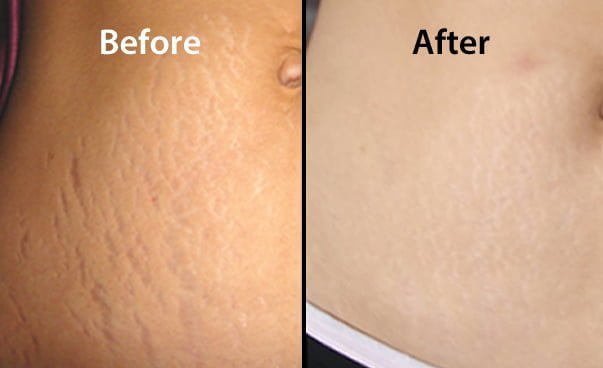 Stretch Marks Removal Treatment via Laser - Jaipur Skincity