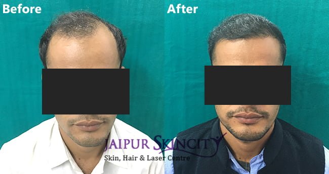Cost of Hair Transplant in Jaipur