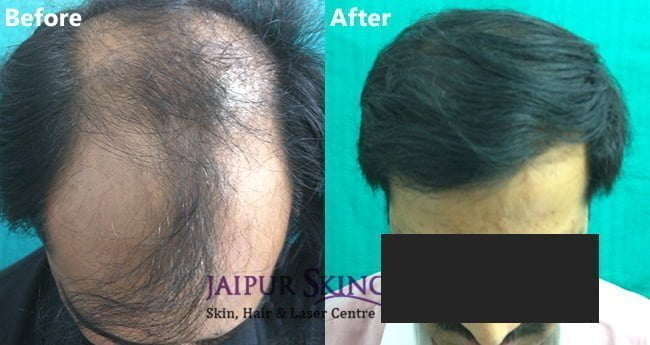 Cost of Hair Transplant in Jaipur