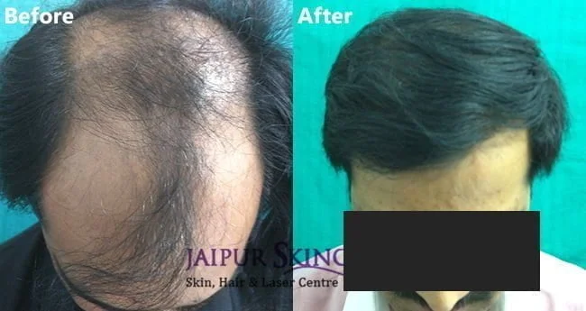 Hair transplant