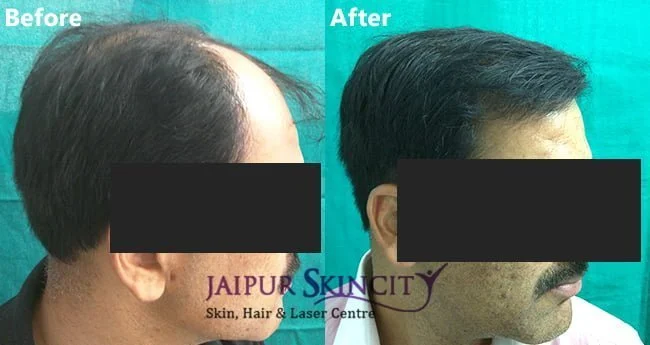 Hair Transplant patient image