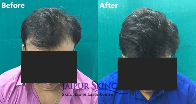 After Before of Hair Transplantation