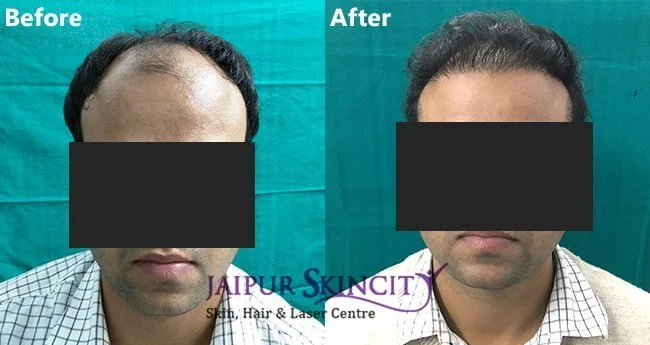 After Before images of Hair Transplant