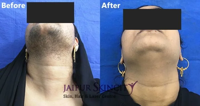 Laser Hair Removal in Jaipur at Best Cost Jaipur Skincity Clinic