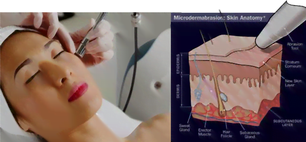 Microdermabrasion-(Skin-Polishing)