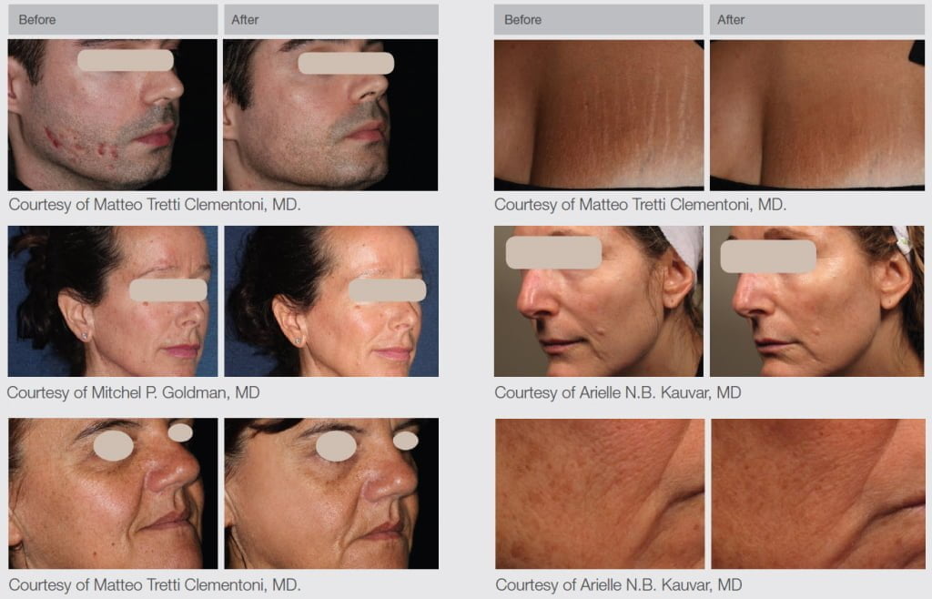 ResurFX-before-after-images