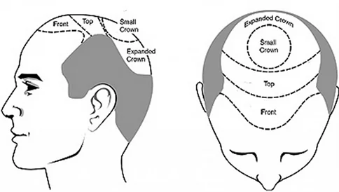 cost-of-hair-transplant-in-jaipur