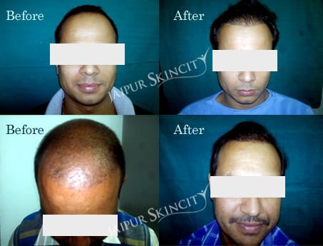 hair transplant