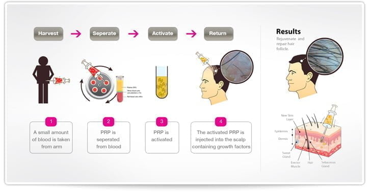 how-prp-works