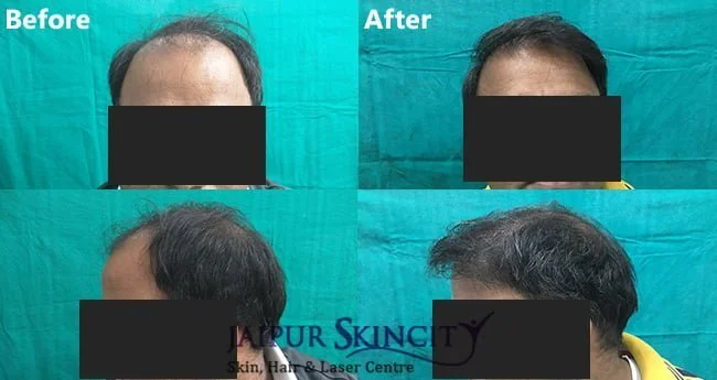 After before hair transplant treatment