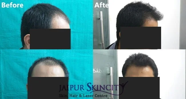 After before hair transplant treatment images
