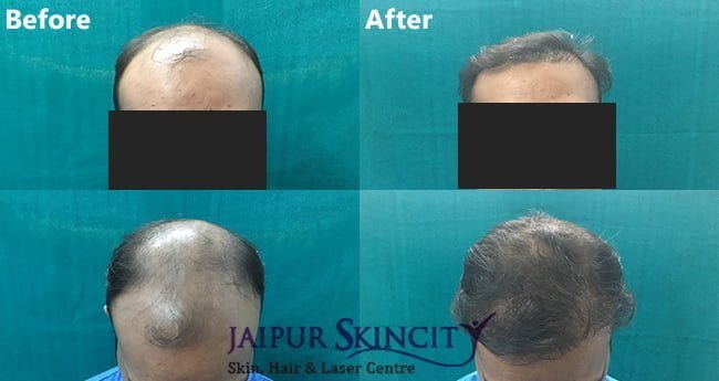Hair Transplant Cost in Jaipur