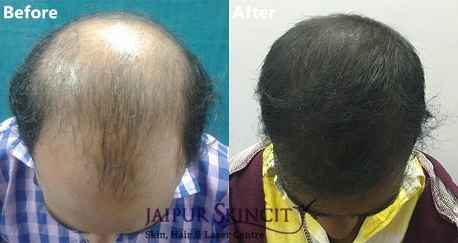Hair Transplant in Jaipur