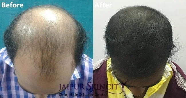 Hair transplant treatment