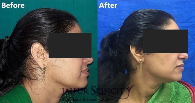 Best Laser Hair Removal in Jaipur - Jaipur Skincity