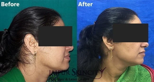 laser treatment in jaipur