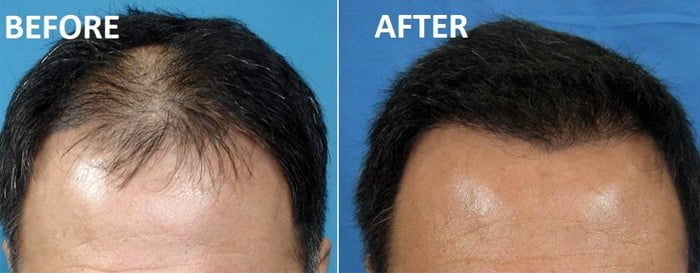 prp-hair-loss-jaipur