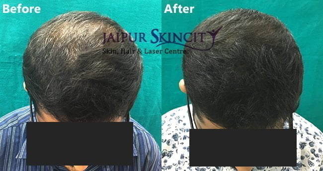 Best PRP Hair Loss Treatment in Jaipur - Jaipur Skincity