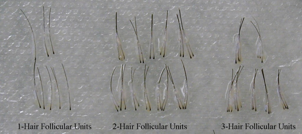 Hair Follicular Units Cost in jaipur