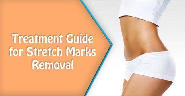 treatment guide for stretch marks removal