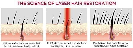 Laser Hair Therapy  Treatment for Hair Loss