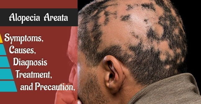 Alopecia Areata Signs Symptoms Causes Diagnosis and Treatment