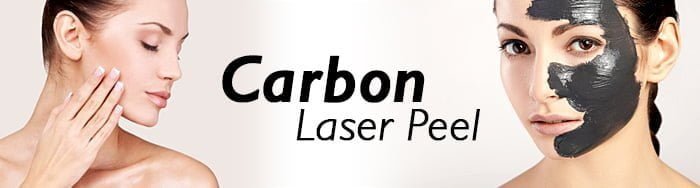 carbon laser peel