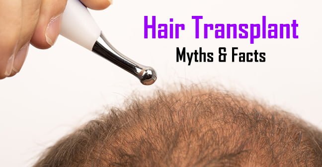 hair transplant myths and facts