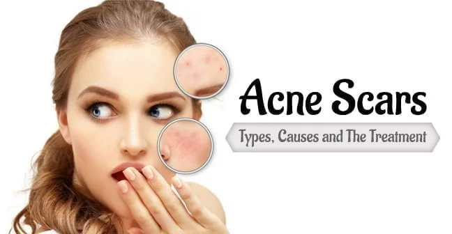 acne scars