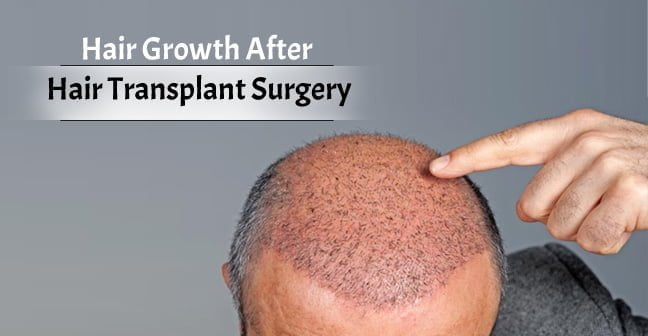Hair Growth After Hair Transplant Surgery