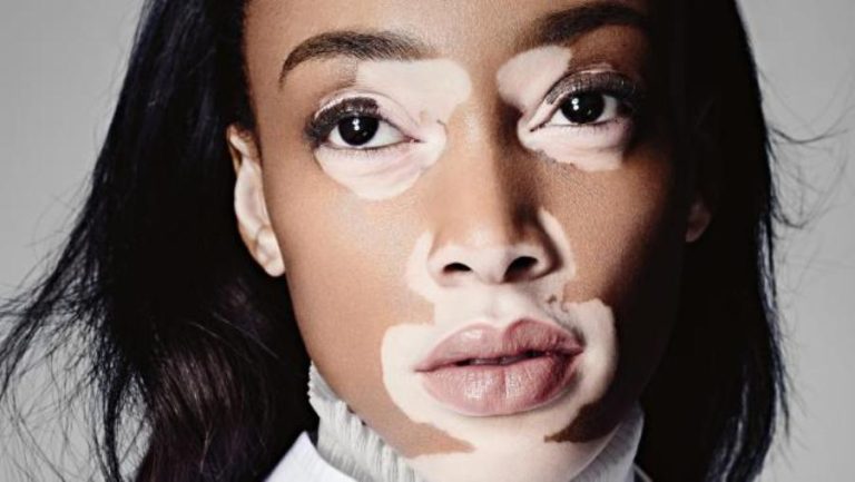 vitiligo-symptoms-causes-and-treatment-options