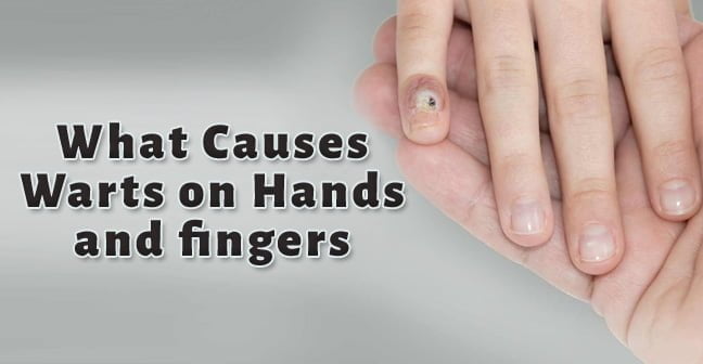 What Causes Warts on Hands and fingers