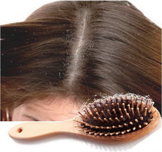 does dandruff causes hair loss and hair fall