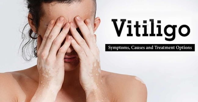 vitiligo symptoms