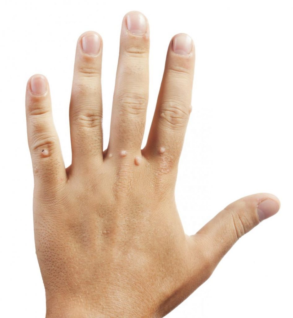 What Causes warts on hands and fingers