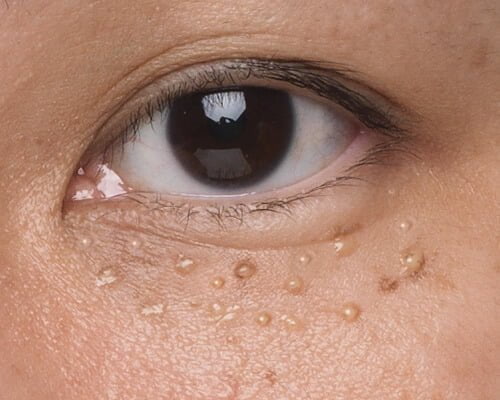 milia-causes-milia-on-face-eyelid-how-to-get-rid-of-it