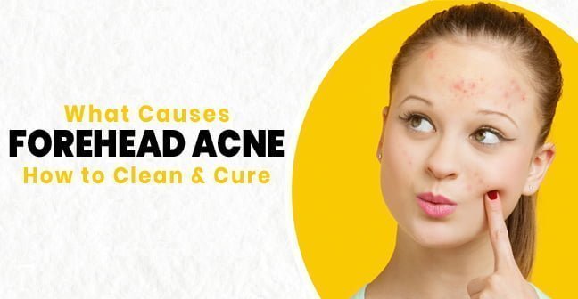 forehead acne