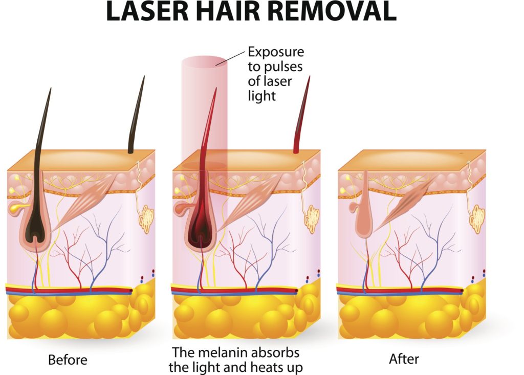 is laser hair removal painful