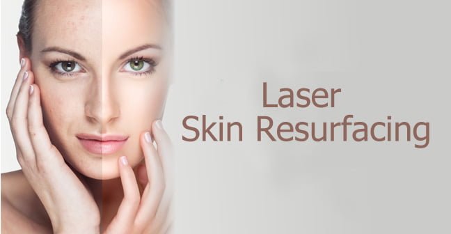 laser skin resurfacing iamge