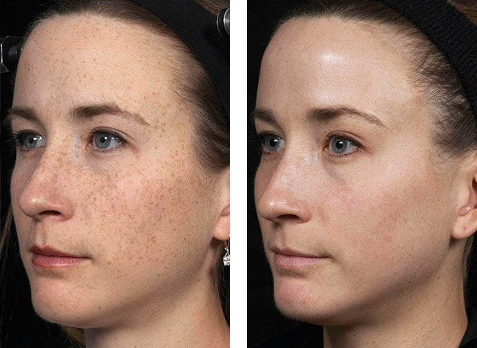 laser skin resurfacing results