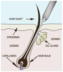 how to remove unwanted hairs from face