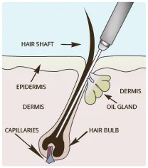 how to remove unwanted hairs from face