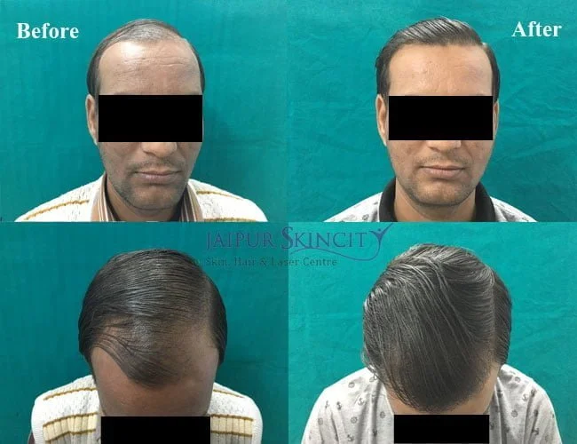 Best Doctor For Hair Loss Treatment in Jaipur  Dr Sachin sharda