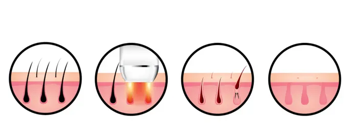 How laser hair removal works in jaipur