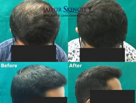 PRP Hair Loss Treatment